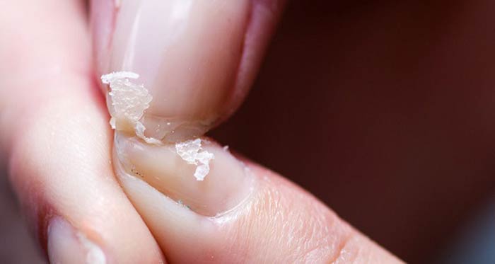 Brittle nails: Toenails fingernails causes and treatment