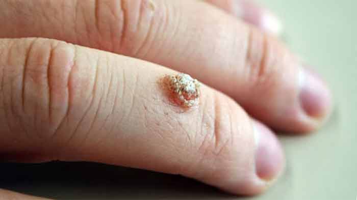 clear nail polish warts